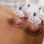 Cupping in Acupuncture